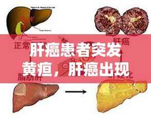 肝癌患者突发黄疸,肝癌出现黄疸是不是活不了几天了